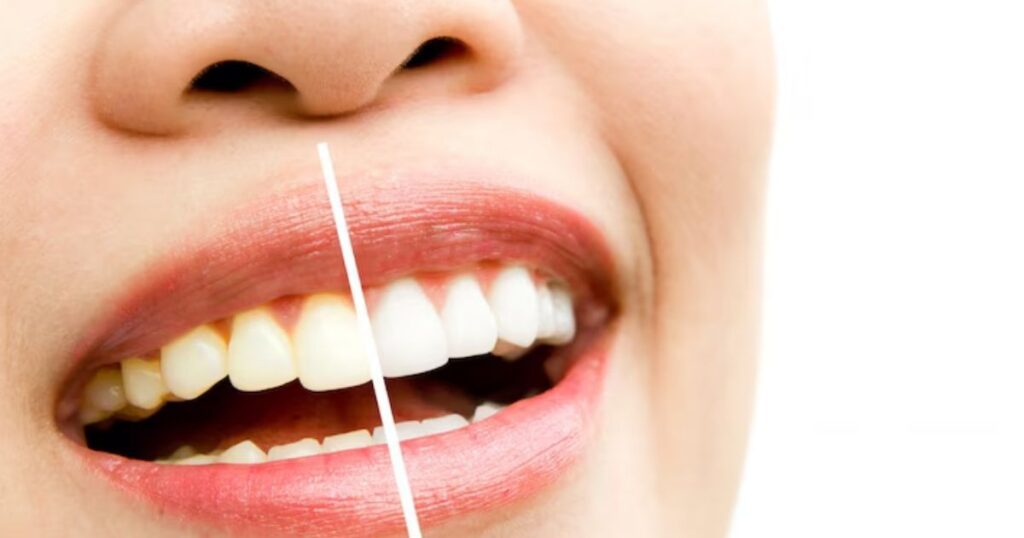 Teeth Whitening Before and After: Transform Your Smile