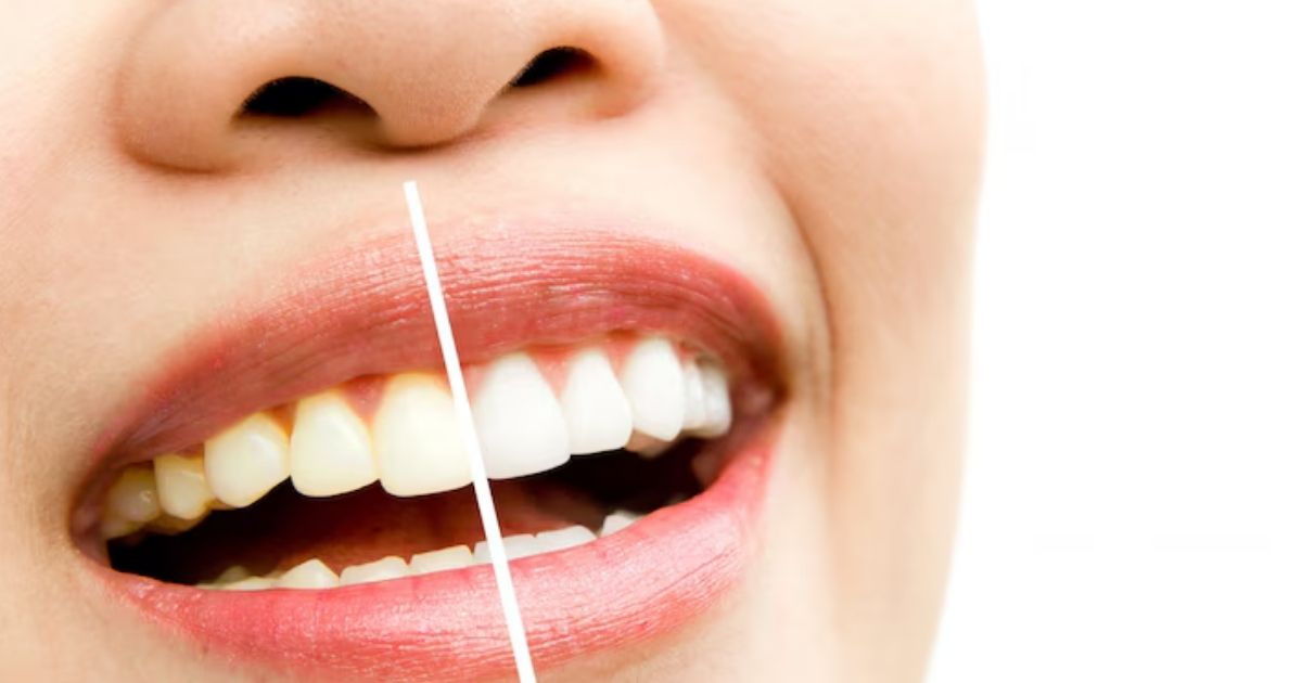 Teeth Whitening Before and After: Transform Your Smile